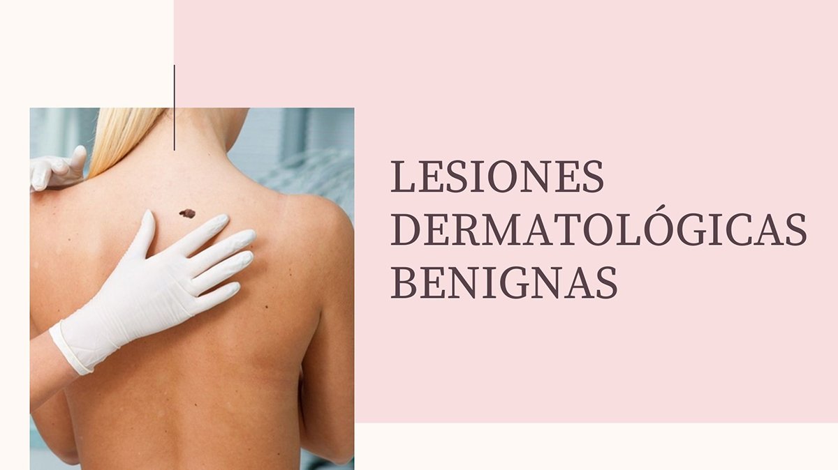 Lesiones Dermatologicas Benignas