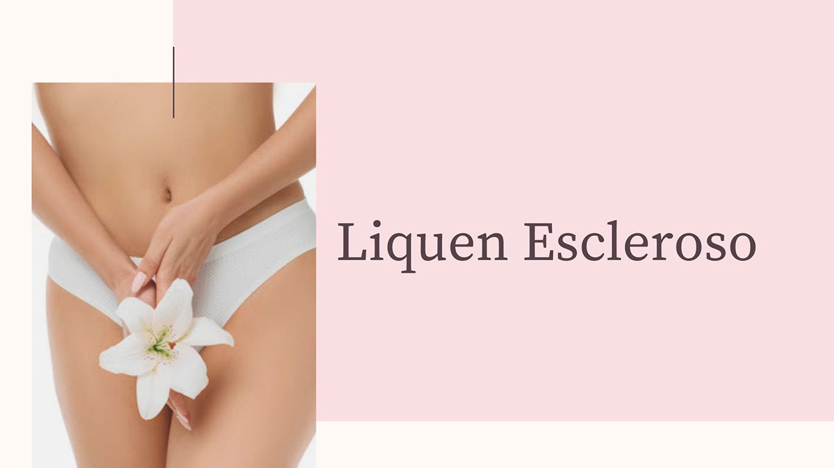 Tratamiento Liquen Escleroso en Madrid, es una enfermedad crónica que se presenta con mayor frecuencia en la zona genital, tanto masculina como femenina, aunque puede aparecer en otras zonas del cuerpo. Puede aparecer a cualquier edad, pero es más frecuente en la época previa a la pubertad y en mujeres postmenopáusicas.